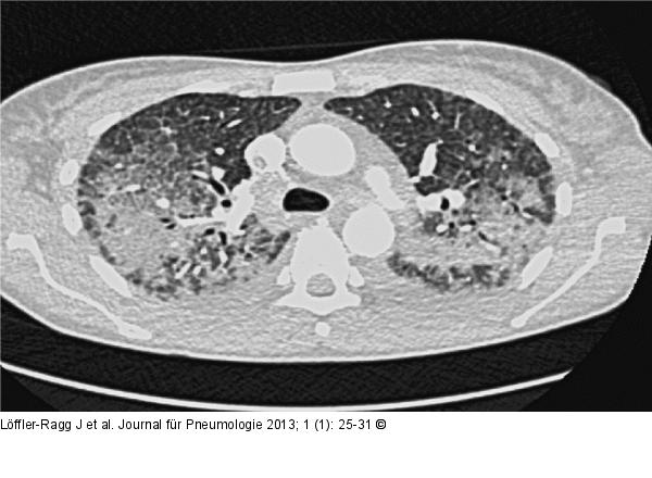 Eosinophilie