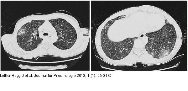 Eosinophilie