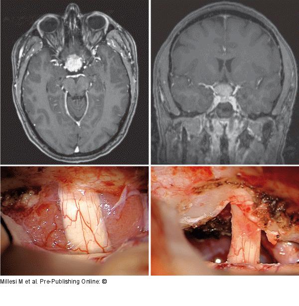 Intracranial Meningioma