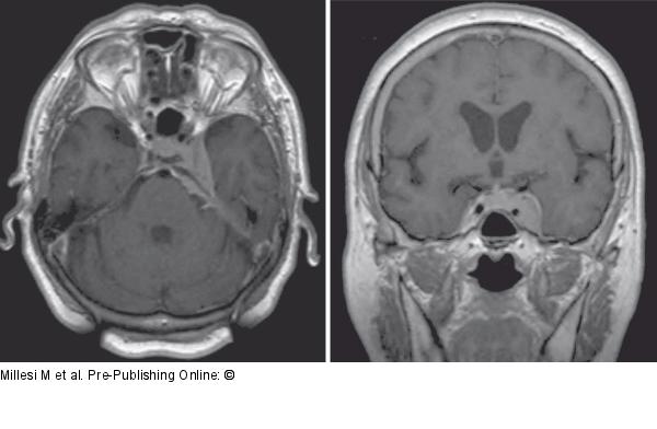 Intracranial Meningioma