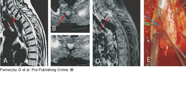 Spinal Meningioma