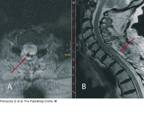 Spinal Menigioma