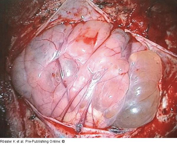 Brain-Collision-Tumour