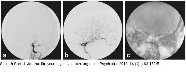 Schlaganfall-Management