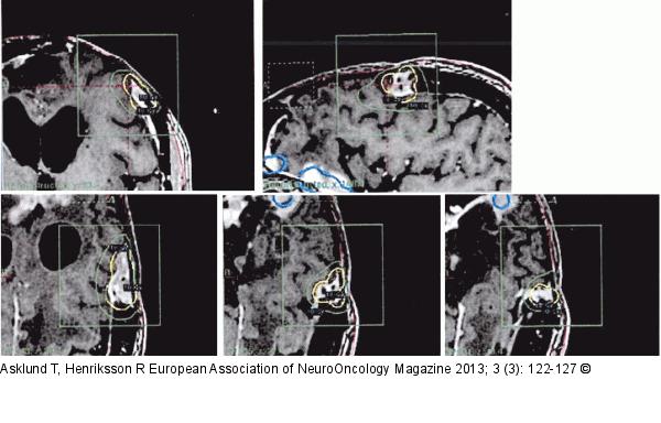 Radiotherapy - Meningioma