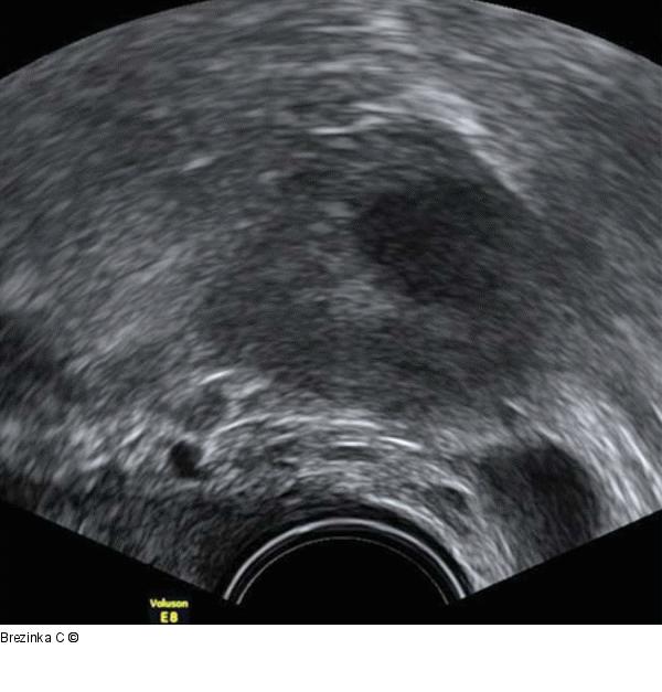 Gyn-Ultraschall