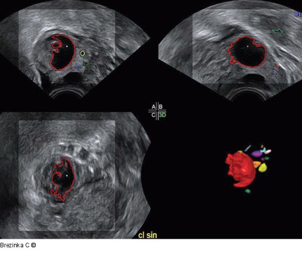 Gyn-Ultraschall