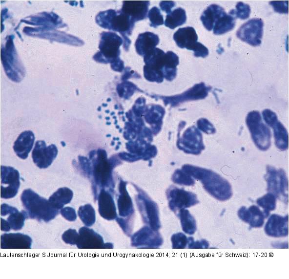Urethritis