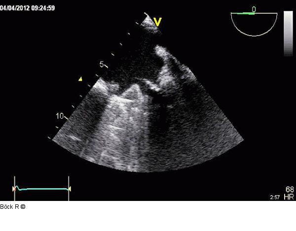 TEE - Mobilisation - Klappenflügel
