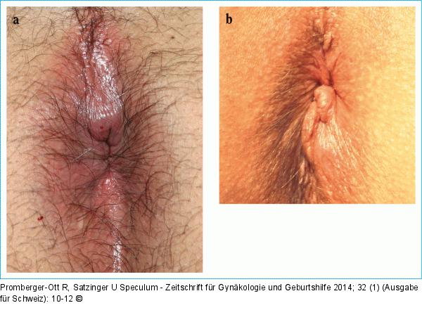 Hämorrhoiden