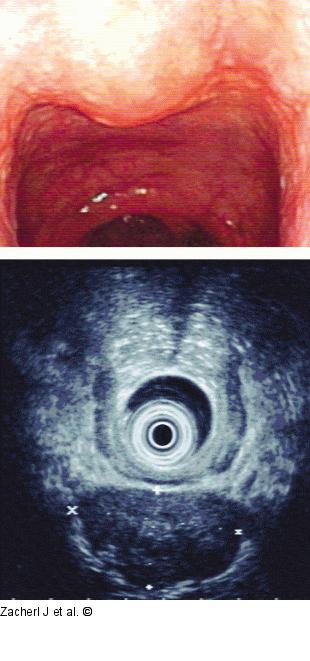 Submukosaler Tumor