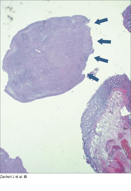 Submukosaler Tumor