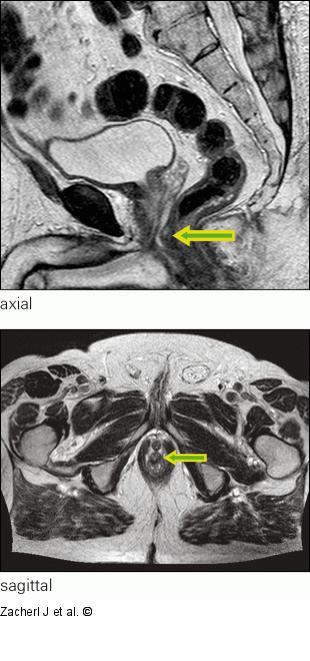 Submukosaler Tumor