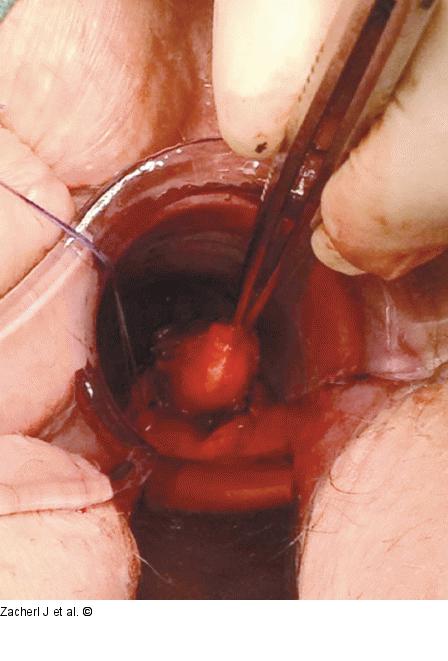 Submukosaler Tumor