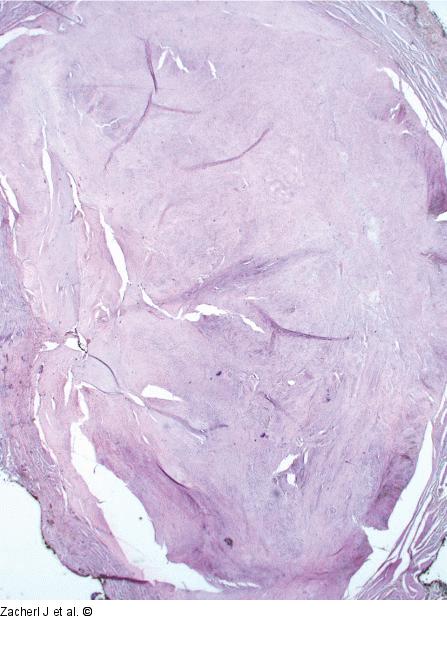 Submukosaler Tumor
