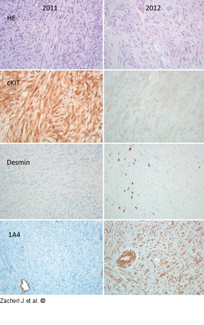 Submukosaler Tumor