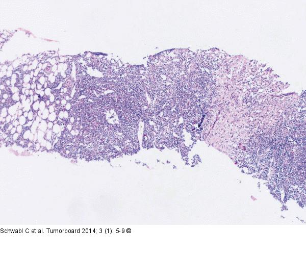Follikuläres Lymphom