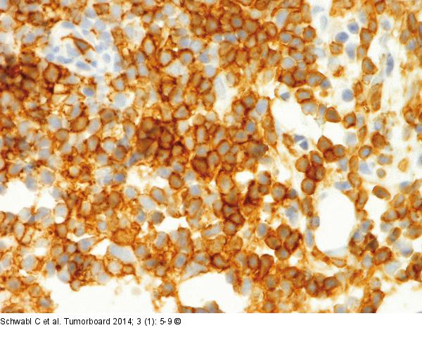 Follikuläres Lymphom