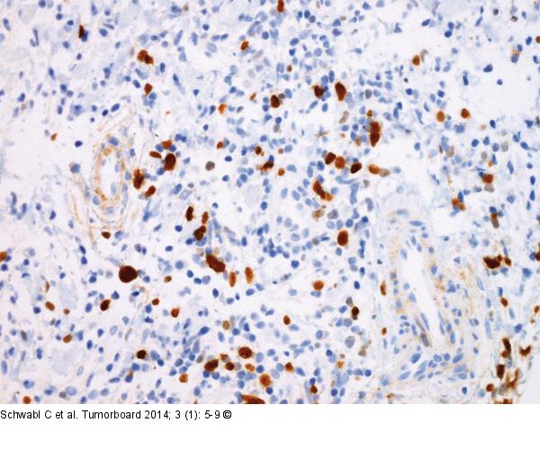 Follikuläres Lymphom