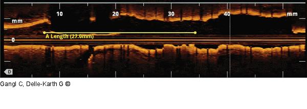 OCT- RCA - Stent