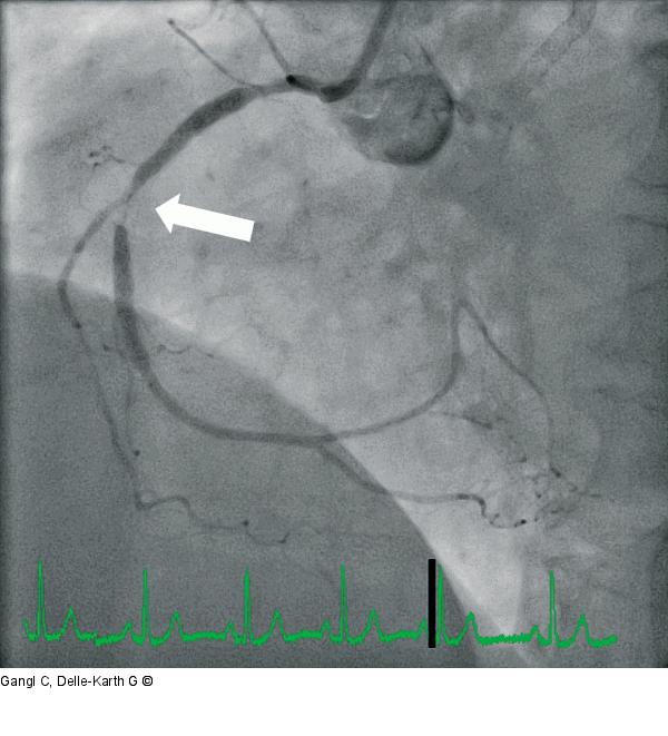 In-Stent-Restenose