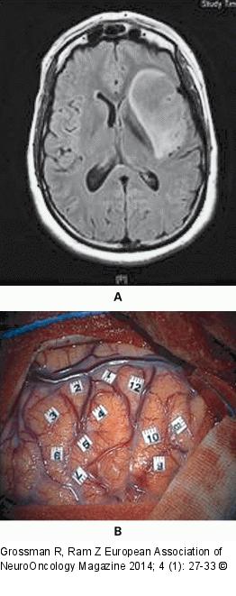 Awake Craniotomy