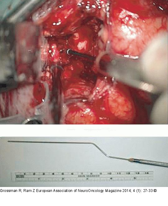 Awake Craniotomy
