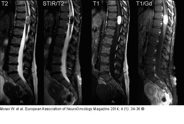 Spinal Teratoma