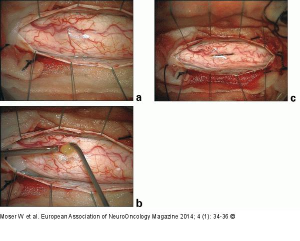 Spinal Teratoma
