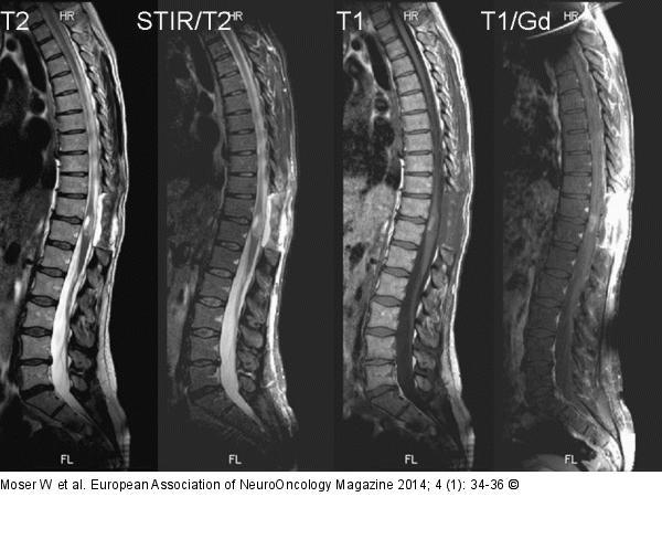 Spinal Teratoma