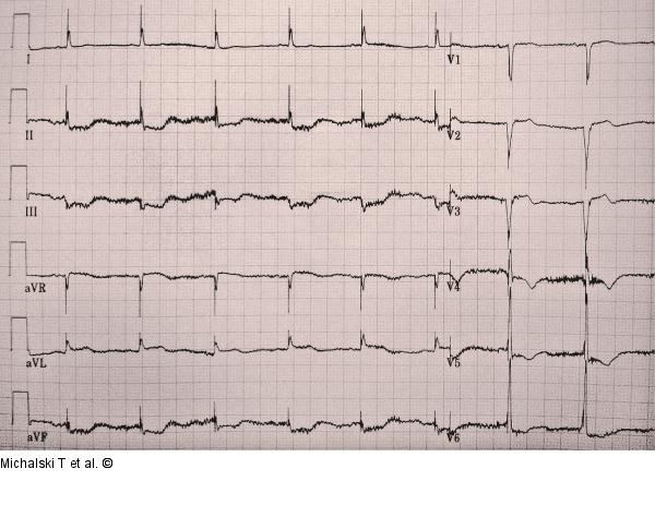 EKG-Beispiel