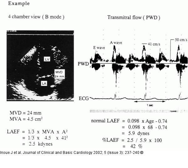 LAEF (Left Atrial Ejection Force)