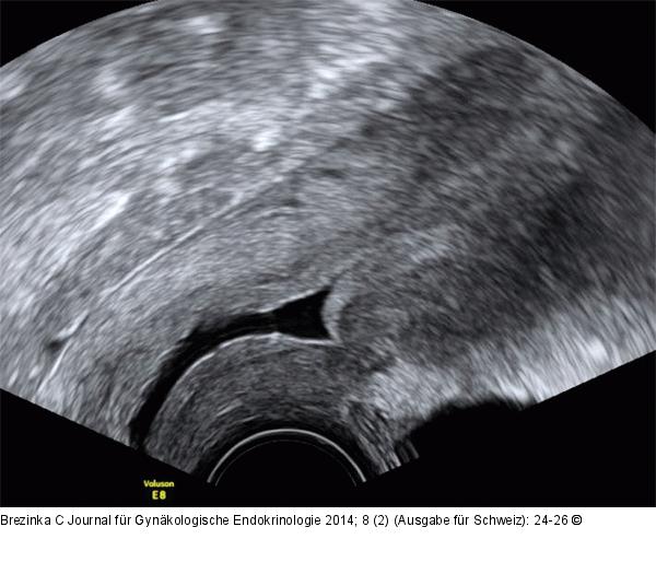 Gyn-Ultraschall