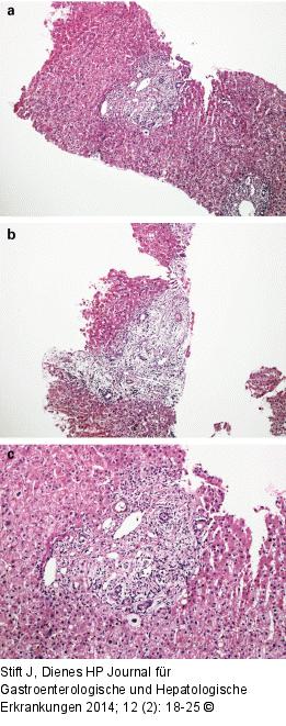 Transplantatabstoßung