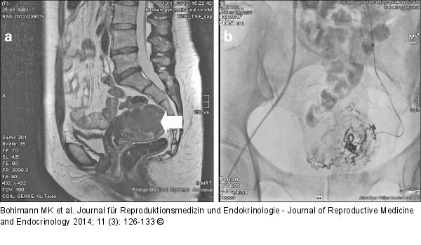 Uterus myomatosus 