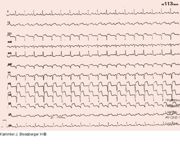 EKG