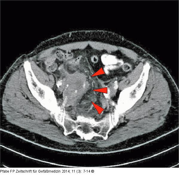 Iliakalaneurysma