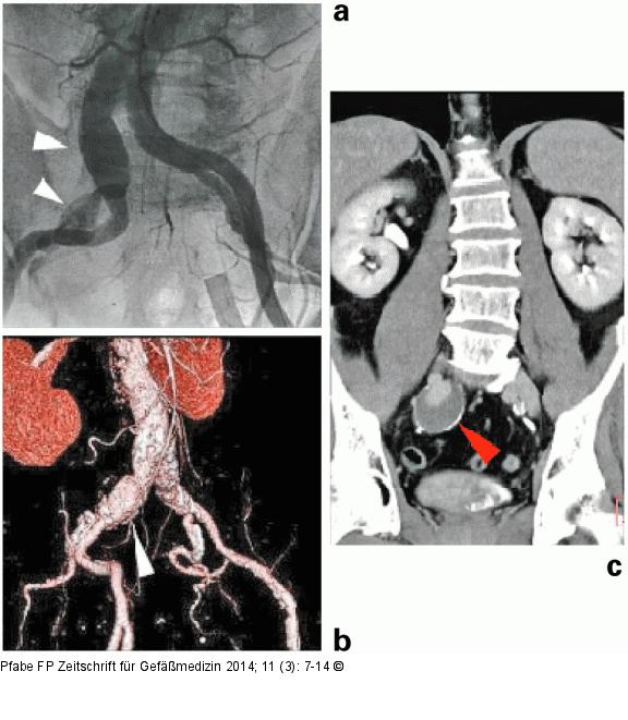 Iliakalaneurysma
