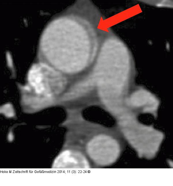 Aorta ascendens