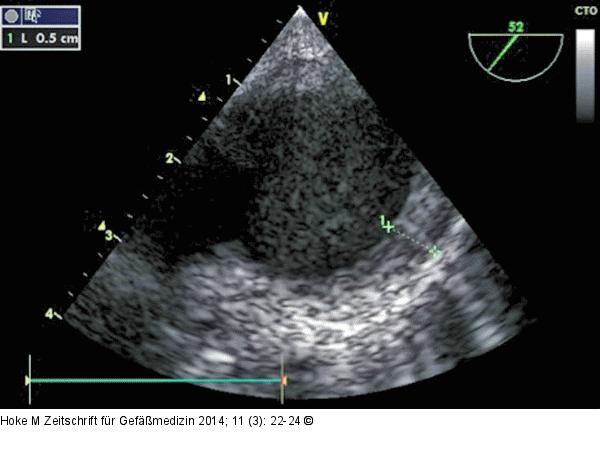 Aorta thoracica