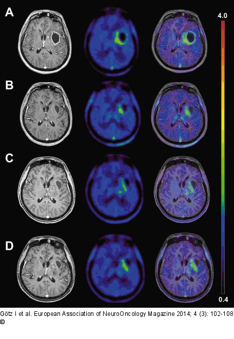 Glioblastoma