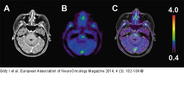 Distant Tumour