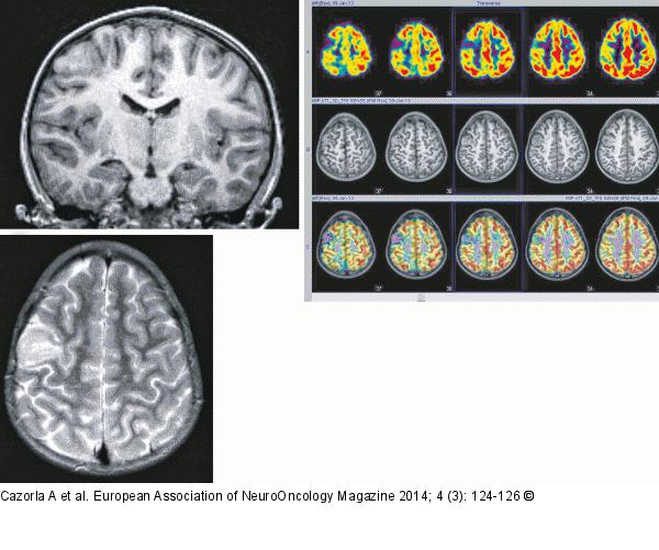 Angiocentric glioma