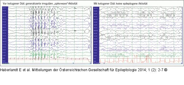 EEG - Ketogene Diät