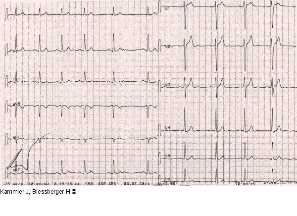 Ruhe-EKG