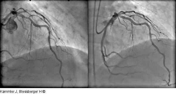 Angiogramm