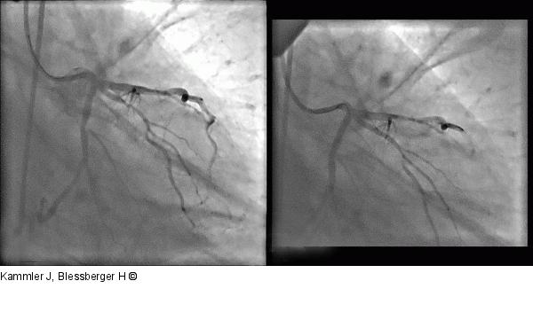 Angiogramm
