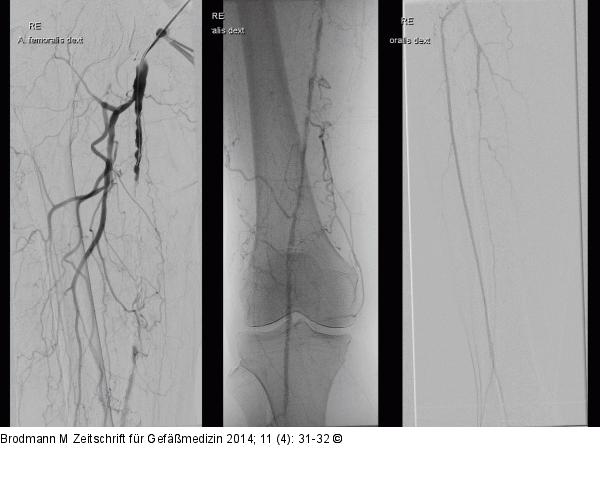 CTO-Revaskularisation