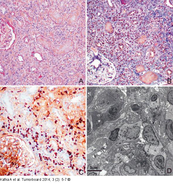 Hyper-IgG-Syndrom