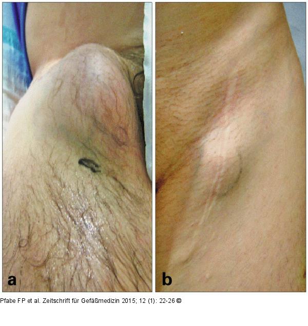Aneurysma